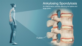 Ankylosing Spondylitis: Causes, Symptoms, Diagnosis, and Treatment Ankylosing Spondylitis: Causes, Symptoms, Diagnosis, and Treatment